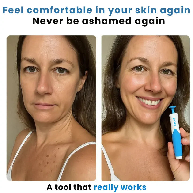 QIAWI Skin Tag Remover Kit — Gentle, Fast & Pain-Free