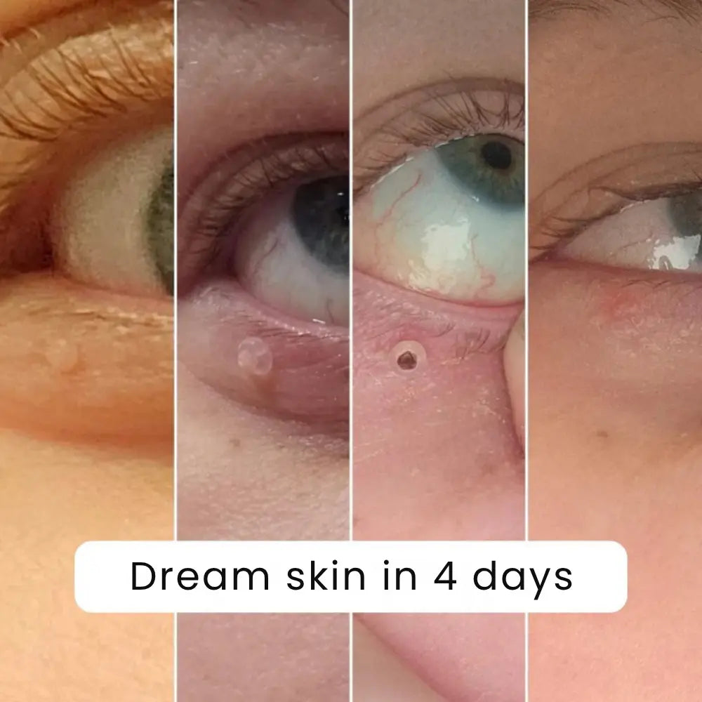 QIAWI Skin Tag Remover Kit — Gentle, Fast & Pain-Free