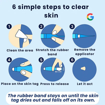 QIAWI Skin Tag Remover Kit — Gentle, Fast & Pain-Free