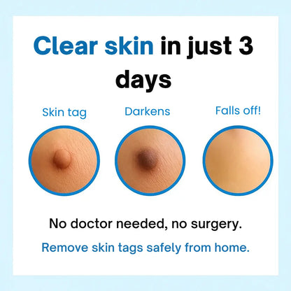 QIAWI Skin Tag Remover Kit — Gentle, Fast & Pain-Free